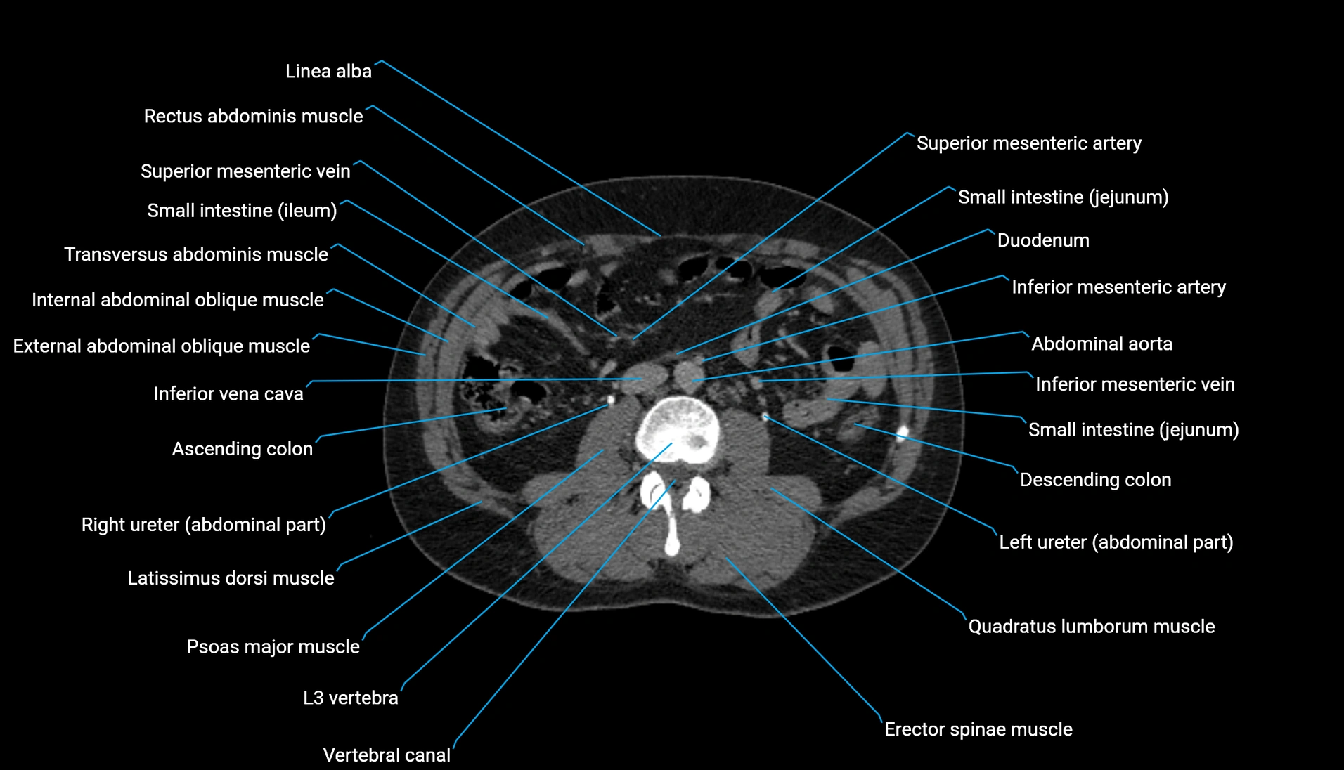 CT urogram axial cross sectional anatomy  labelled radiology image-00127.webp